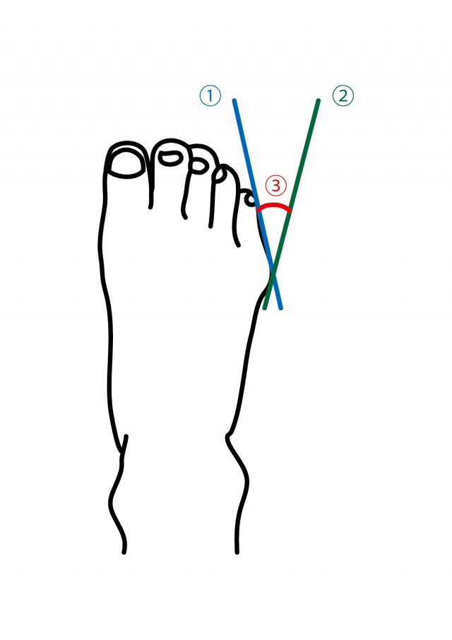 反 小 治し 方 趾 内 内反小趾の治療法とは。効果的な矯正法はあるのか？｜外反母趾を治す！